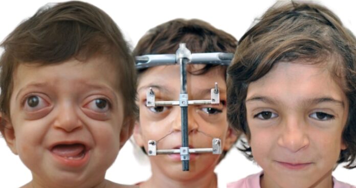 Crouzon-Syndrome-1